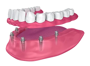 dental-implant-dentures