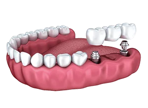 dental-implant-multiple-teeth