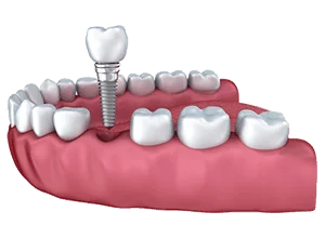 dental-implant-single-tooth